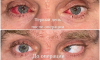Врачи вылечили воронежца, который 20 лет страдал косоглазием