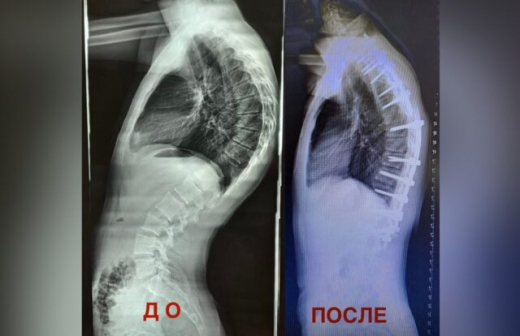 Искусственный перелом кости применили воронежские врачи для спасения подростка