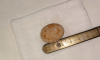 Воронежские врачи извлекли из мочевого пузыря 1,5-годовалого ребёнка 3-сантиметровый камень